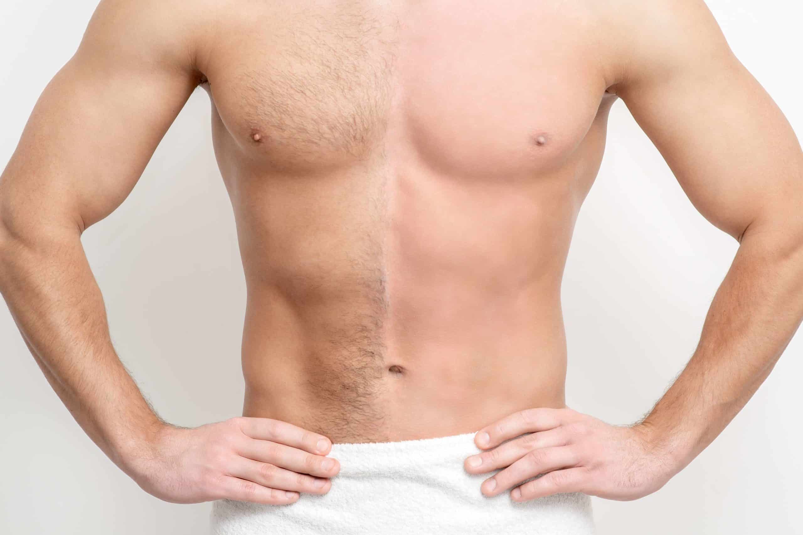 Laser Hair Removal Holly Springs and Raleigh, NC