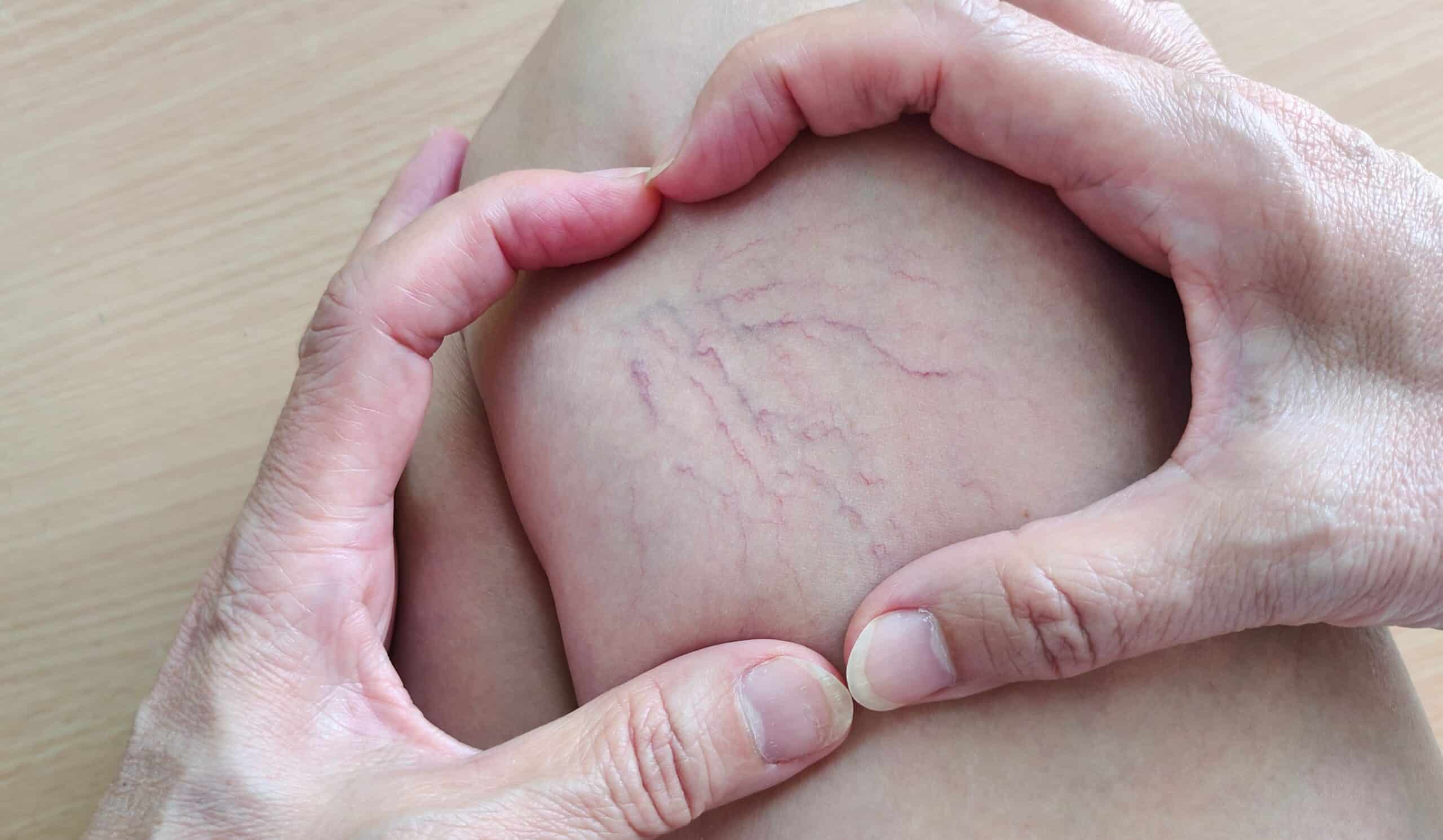 Laser Spider Vein Removal in Holly Springs, NC | SKYNN MD